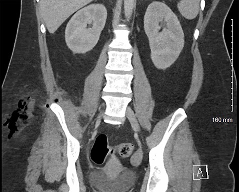 Coronal CT image of patient’s pelvis/abdomen demonstrating fistula tract containing gas and fluid from the intra-abdominal space through the inferior lumbar triangle into the soft tissue of the flank/proximal thigh.