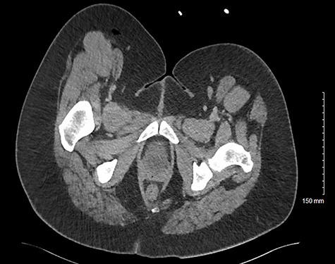 Axial CT image of patient at L5 level, demonstrating inflamed perforated appendix adherent to the pelvic sidewall. This also shows an abscess in the subcutaneous fat of the flank/proximal thigh.