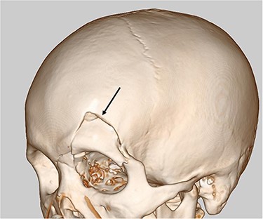Head CT scan revealed open skull fracture reaching the left skull base (arrow) and mild brain contusion.