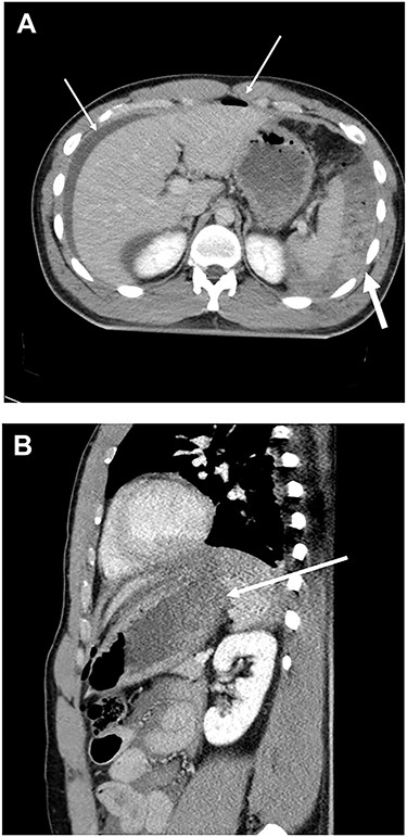 (A) CT scan of abdomen showed free air, ascites (thin arrow) and a large amount of food residue behind the spleen (thick arrow). (B) CT scan of abdomen showed disruption of gastric wall (arrow).