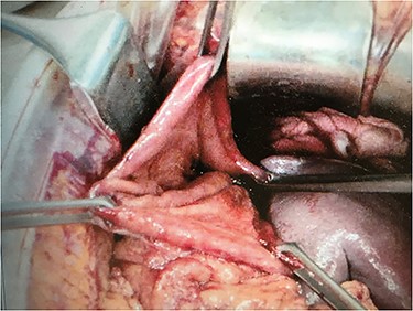 A burst hole of 10 cm was observed from the cardia to the body of the anterior wall at emergency laparotomy.
