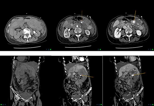 Axial and coronal reformats in non-contrast, arterial and delayed phases demonstrating contrast blush, with pooling within the left hepatic lobe haemangioma consistent with active bleeding.