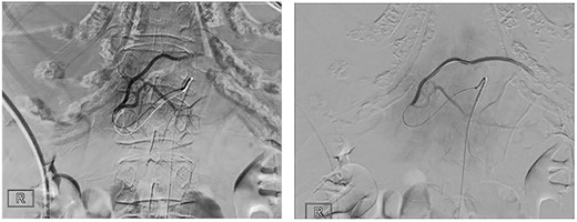 DSA demonstrating hepatic vessels during TAE.