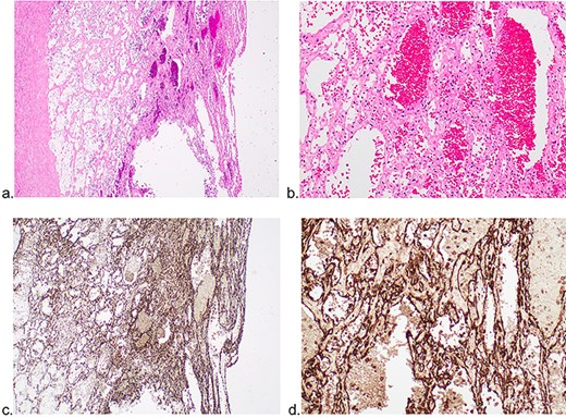 Pathological examination of hepatic mass revealing infarcted tissue and haemorrhage. Preserved areas of variably sized vessels shown.