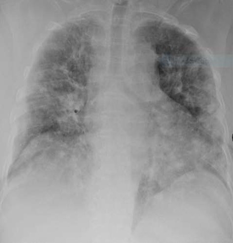 Chest X-ray revealed bilateral homogeneous opacification.
