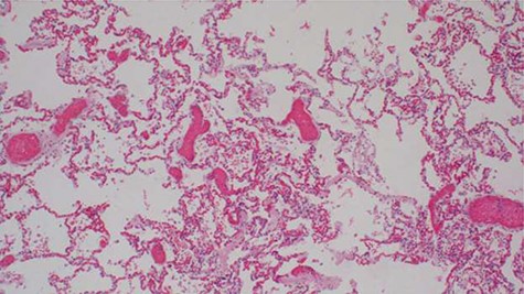 Histopathology of lung tissue showing mixed chronic inflammatory infiltrates and vascular thrombosis (hematoxylin and eosin ×100).