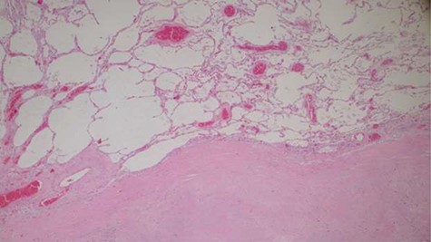 Histopathology of lung tissue showing vascular thrombosis and extensive fibrosis and necrosis (hematoxylin and eosin ×40).