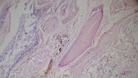 Histopathology of the bowel tissue showing ischemic necrosis and the vascular thrombosis (hematoxylin and eosin ×100).