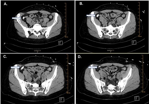 CT of the abdomen and pelvis. Serial images (A–D) from cephalad to caudal show a large fecalith (arrows).