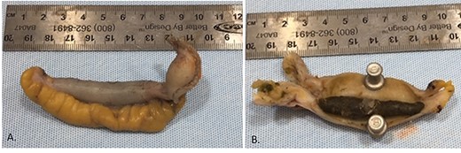 Appendiceal specimen received by pathology (A). There is a 5.0 × 0.8-cm tan/dark green fecalith filled within the lumen of the appendix (B).