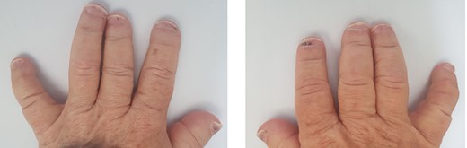 Impressive splinter haemorrhages of both hands at the time of presentation.