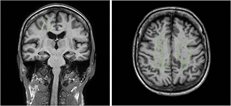MRI brain demonstrating multifocal infarctions in both the anterior and posterior circulation, consistent with a cardioembolic source.
