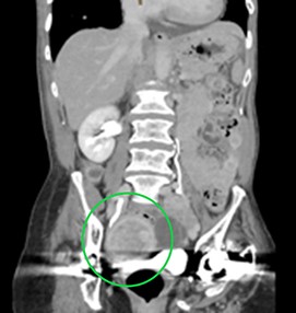 CT aortogram demonstrating a suspicious lesion arising from the right adnexa. Ultrasound confirmed a complex, vascular lesion arising from the right ovary and later biopsy proven as high-grade serous ovarian cancer.