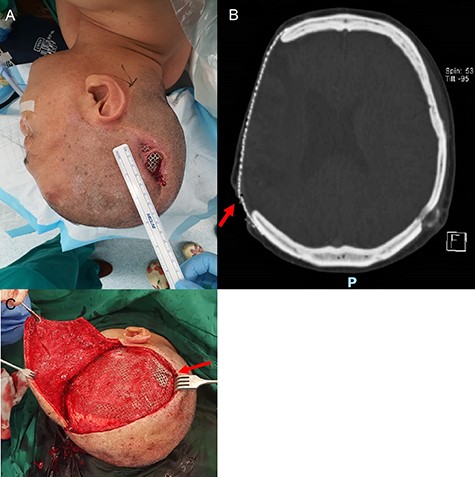Parietal scalp wound with an exposed implant. A 54-year-old man presented with a right parietal scalp wound measuring 5 × 2.5 cm, with exposed titanium mesh cranioplasty implant (A). Computed tomography showed outward tenting of the implant beneath the area of exposure (B). This was correlated intraoperatively, due to venting cuts made from the initial surgery (C). This had likely caused pressure on the overlying skin and resulted in skin breakdown and implant exposure.