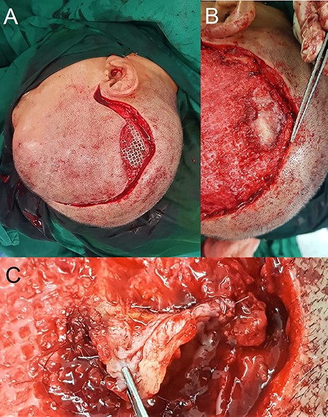 Intra-operative findings of hair-bearing skin beneath the exposed implant. The wound was debrided and incision extended along the previous scar (A). Upon removal of the implant, we found a layer of epithelium with hair follicles and surrounding granulation tissue beneath the area of the exposed implant (B, C); this was fully excised down to the dural covering layer and sent for histopathology.