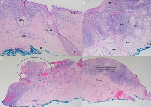 Histopathology findings. (A, B) Haematoxylin–Eosin staining (×40): micrographs showing skin with pilosebaceous units and prominent chronic inflammation in the superficial dermis with exocytosis. SebG = sebaceous gland; EccG = eccrine glands; DEJ = dermo-epidermal-junction; HF = hair follicle; PsU = pilosebaceous unit (black arrow). (C) Haematoxylin–Eosin staining (×20): Nodular protrusions of skin (blue circle), corresponding to gaps/holes within titanium mesh. (D) Haematoxylin–Eosin staining (×20): marked dermal inflammation with lichenoid bands and fibrosis, with varying degrees of epidermal hyperplasia (black double-arrows) lending support to our hypothesis of re-epithelialisation between skin islands. Epidermis is relatively thinner towards the edge of the specimen (yellow double-arrow), corresponding to the interface with the edge of the exposed implant.