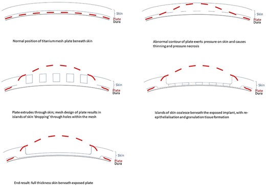 Proposed mechanism of dermointegration. In the normal patient, the titanium plate lies between the dura and overlying scalp skin (top left). Local factors such as abnormal plate contour exert pressure on the skin and causes thinning and pressure necrosis (top right). The plate extrudes through the skin, and the mesh plate design results in islands of the skin ‘dropping’ through holes within the mesh (middle left). Islands of skin coalesce beneath the exposed implant, with re-epithelialisation and granulation tissue formation (middle right). The eventual result is a layer of full-thickness skin overlying and protecting the dura beneath the exposed plate (bottom left).