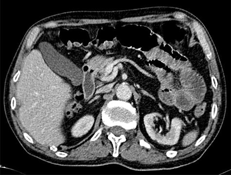CT scan targetlike finding. Contrast enhanced CT scan of the abdomen demonstrates the typical multi-layered appearance of a small bowel intussusception. The intussusceptum is accompanied by a mesenteric fat and blood vessels and surrounded by the thick-walled intussuscipiens, the target-like finding, pathognomonic for intussusception.