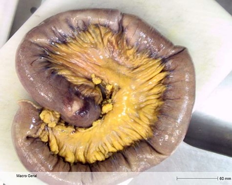 Macroscopic specimen examination. Final anatomopathological examination revealed 60 cm long enterectomy specimen, with 4 polypoid lesions, which caused in areas retraction of the serosa (at 10.5 cm, 23.5 cm and 54 cm from the proximal margin).