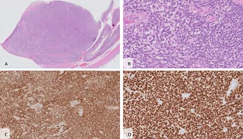 Microscopic features. (A) The lesion shows mural and diffuse infiltration of atypical cells (haematoxylin and eosin (H&E), x20) (B) forming nests, arranged around vascular structures with papillary-like growth; the cells present big ovoid nuclei with vesicular chromatin and occasional nucleoli and no pigment was seen (H&E, x200); immunohistochemical staining showed that the malignant cells were diffuse positive for PS100 (C) and SOX10 (D), characteristic of melanoma.
