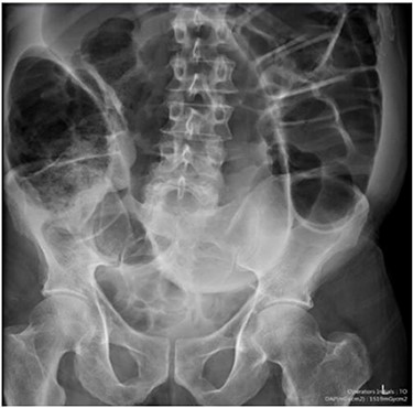 Case one: plain abdominal film showing dilated large bowel and the ‘coffee bean’ sign associated with sigmoid volvulus.