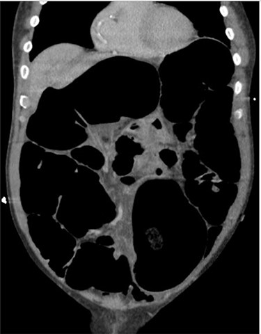 Case one: coronal slice of a CT scan of the abdomen and pelvis with intravenous contrast showing dilated large bowel.
