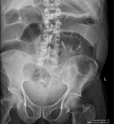 Case one: a plain abdominal film consistent with postoperative ileus.