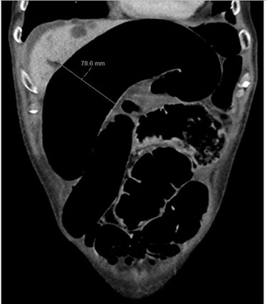 Case two: a coronal slice of a CT scan of the abdomen and pelvis with intravenous contrast showing dilated large bowel loops; the radiology report suggested sigmoid volvulus with a centrally lying caecum.
