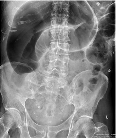 Case two: a plain abdominal film showing dilated large bowel and the ‘inverted comma’ sign associated with caecal volvulus.