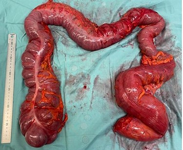 Case two: subtotal colectomy specimen showing dilated caecum and sigmoid colon.