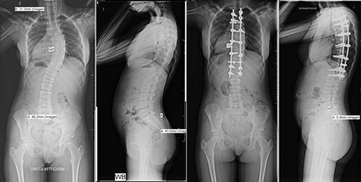 Pre- and post-operative spinal X-rays demonstrating 54° scoliosis curve, corrected with posterior fusion from T3 to L1.