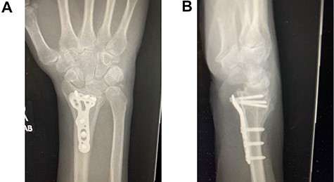 (A and B) PA and lateral radiographs showing failed distal radius fixation with radiocarpal degenerative change.