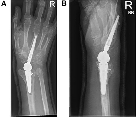 (A and B) PA and lateral radiographs showing a periprosthetic fracture around the metacarpal implant of a Motec wrist replacement.
