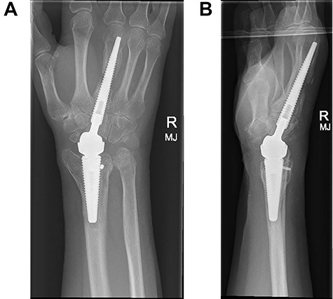 (A and B) PA and lateral radiographs following revision surgery to a longer metacarpal implant.