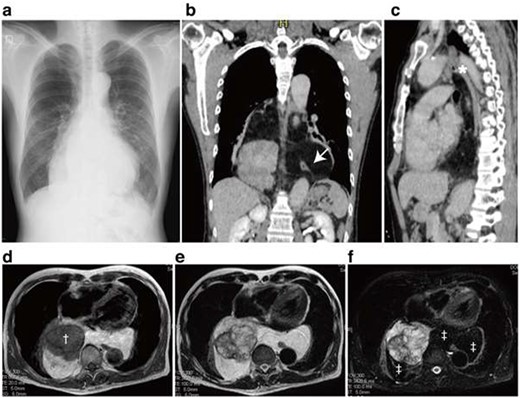 Chest X-ray, computed tomography and magnetic resonance imaging. A Chest X-ray demonstrated enlarged mediastinal shadow (a). Axial section revealed a posterior mediastinal tumor displacing the heart anteriorly (b). The well-capsulated tumor expanded into both thoracic cavities and involved the esophagus (b, Arrow). The superior border of the tumor reached the aortopulmonary window (c, asterisk). Magnetic resonance imaging of the tumor revealed the heterogeneous components in the tumor where a T1-low intensity component (†) was surrounded by fat components (‡) (d–f). T1-weighted image (d), T2-weighted image (e) and Fat-suppressed T2-weighted image.
