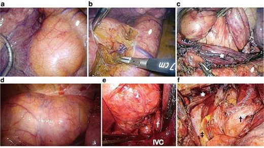 Operative findings. Operative findings in the left thoracic cavity (a–c). The tumor was situated between the aortopulmonary window (a) and diaphragm. The tumor was completely mobilized from the descending aorta (b) and esophagus with a complete thoracoscopic procedure (c). Operative findings in the right thoracic cavity (d–f). Most of the solid part of the tumor was situated in the right thoracic cavity (d). The tumor was dissected from important anatomical structures such as the inferior vena cava (e). The tumor was resected en-bloc via right thoracotomy (f). #Aorta, *Esophagus, †Inferior pulmonary vein, ‡Left lung, IVC; inferior vena cava.