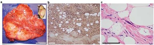 Pathological findings of the tumor. Macroscopic appearance of the resected tumor (a). The tumor cells were homogeneously S100-positive (b). Hematoxylin and eosin staining showed atypical spindle-shaped cells in the tumor (c).