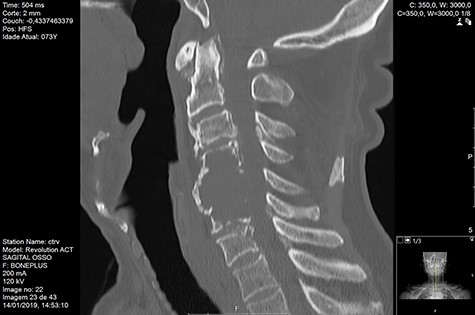CT Sagittal pre-RT.