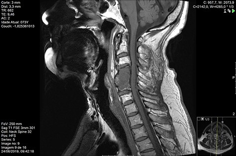 MR sagittal Day 90 post-RT.