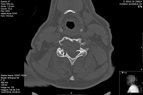 CT axial D120 post-RT.