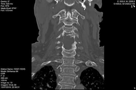 CT coronal D120 post-RT.