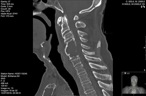 CT sagittal D120 post-RT.
