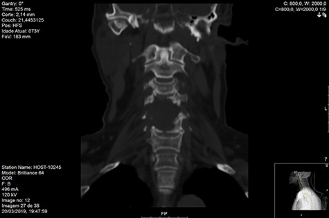 CT coronal pre-RT.
