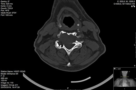CT axial pre-RT.