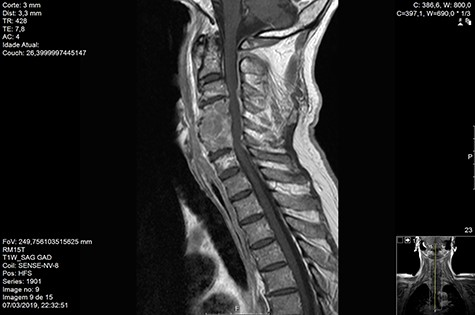 MR Sag T1 contrast pre-RT.