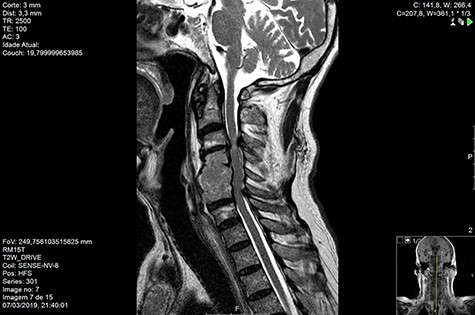 MR Sag T2 drive pre-RT.
