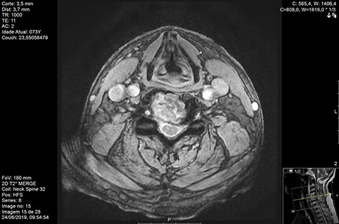 MR axial T2 Day 90 post-RT.