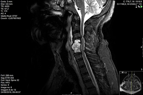 MR sagittal STIR Day 90 post-RT.