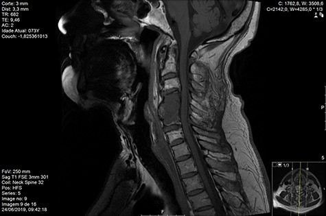 MR sagittal T1 Day 90 post-RT.