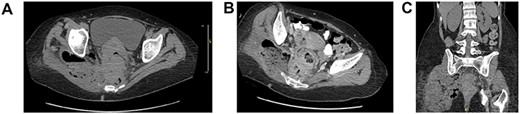 Axial (A, B), coronal (C) CT abdomen and pelvis without contrast: complex right adnexal mass containing gas, measuring ~4.5 × 3.5 cm in size. This does appear to be contiguous with small bowel on the right side of the pelvis. Wall thickening of the rectum noted. Perirectal adenopathy, measuring up to 1.4 cm in diameter. There is perirectal soft tissue, which extends to the mesial rectal fascia, posteriorly adjacent to the sacrum and coccyx and to the right side of the pelvis. There are perirectal air collections noted posteriorly. There is a large complex collection which extends through the sciatic notch into the right gluteus muscle, measuring ~9 × 6 cm, containing air and possibly feces. This collection also extends in inferiorly to the level of the ischial spine.